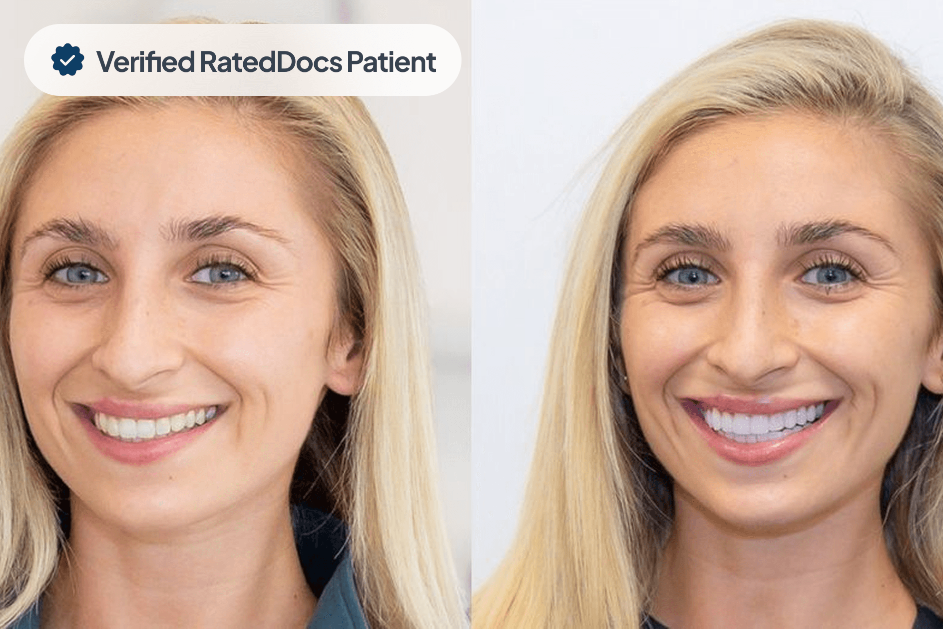 Composite Fillings Before