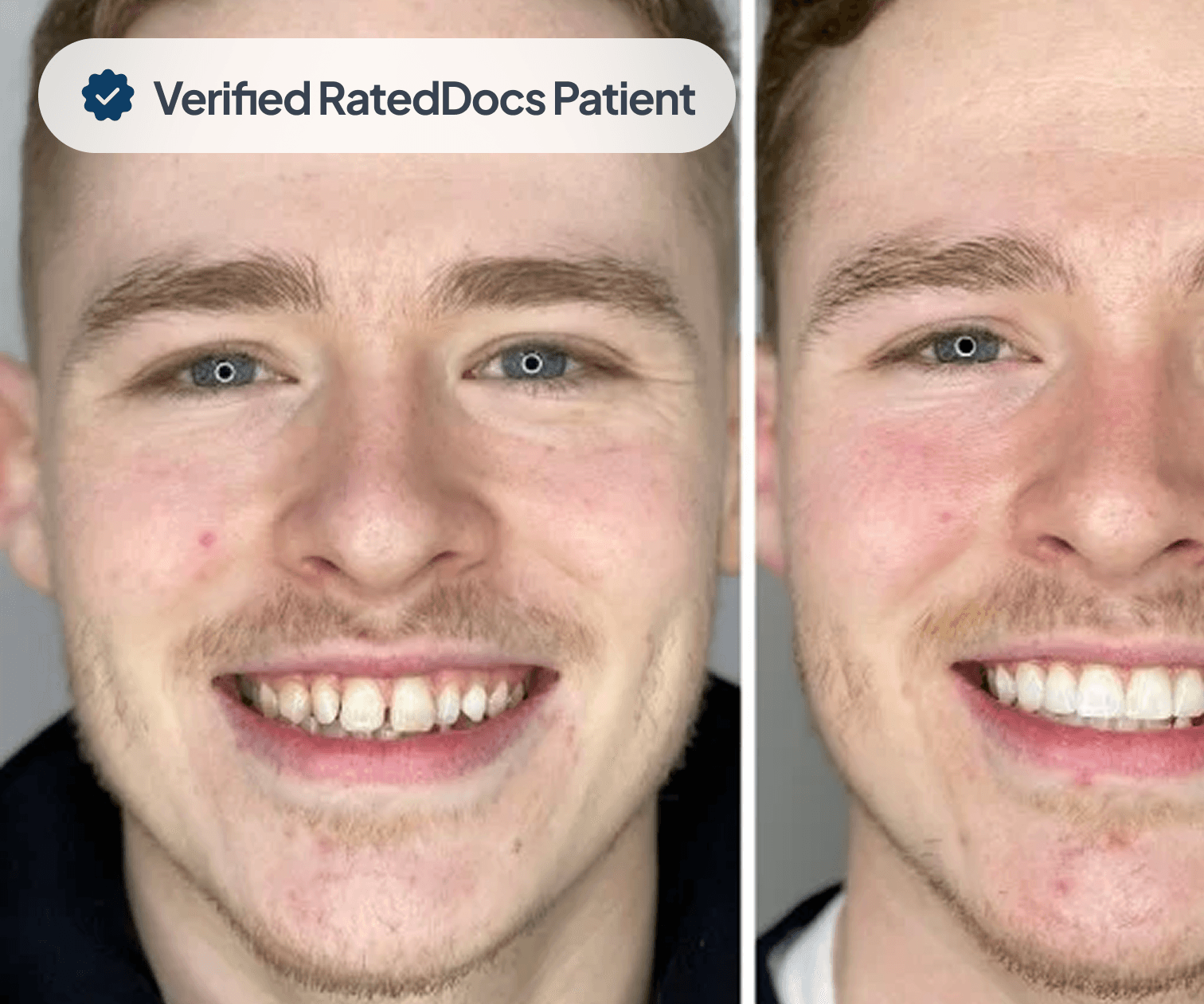 Invisalign Treatment Before
